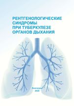 Рентгенологические синдромы при туберкулезе органов  дыхания