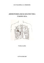 Дифференциальная диагностика туберкулеза