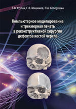 Компьютерное моделирование и трехмерная печать в реконструктивной хирургии дефектов костей черепа
