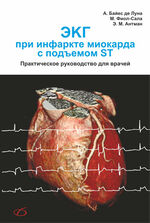 ЭКГ при инфаркте миокарда с подъемом ST