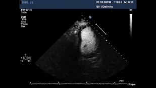 Обложка: Рис. 3.6 Визуализация из трансгастрального доступа. Видео Б Позиция приточного отдела правого желудочка (ПЖ).