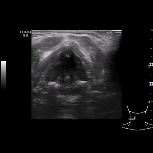 Обложка: 1.4 Ультразвуковое исследование гортани при обследовании парализованной правой истинной  голосовой связки