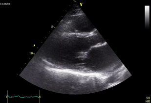 Обложка: Ревматический тяжелый митральный стеноз (рис. 7.2)