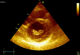 Обложка: Ревматический умеренный митральный стеноз (рис. 7.3)