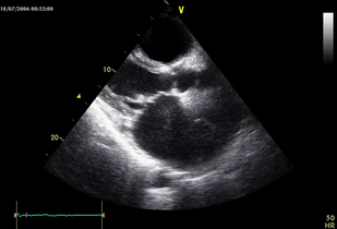 Обложка: Ревматический митрально-аортальный порок сердца с преобладанием митрального стеноза (рис. 7.7)