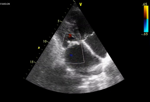 Обложка: Митральный порок сердца с преобладанием митрального стеноза при системной красной волчанке (рис. 7.8)
