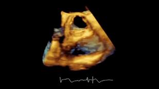 Обложка: Рис. 2.14 Усиление Видео А Аортальный клапан, коэффициент усиления снижен