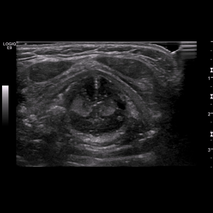 Обложка: 1.1 Истинные доброкачественные узлы в поперечном сечении