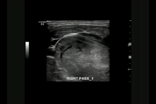 Обложка: 1.5 Поперечная техника тонкоигольной аспирационной биопсии под контролем ультразвукового исследования